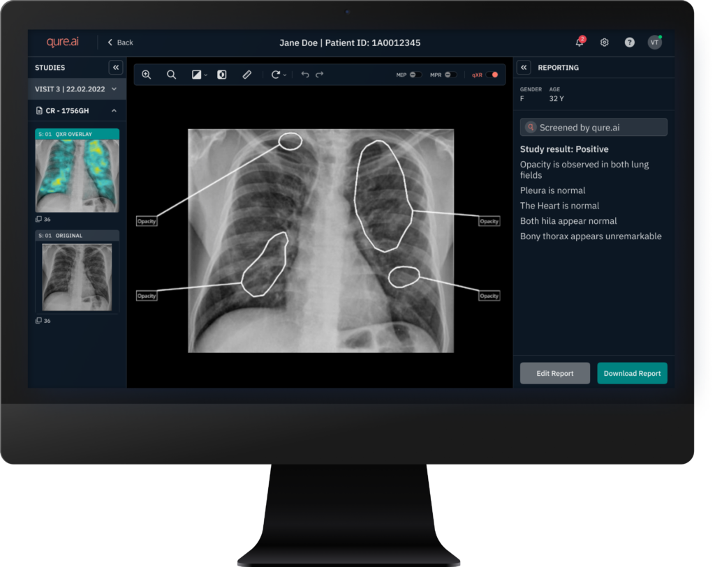 Image of computer screen showing the RADICAL AI-powered X-ray reporting system