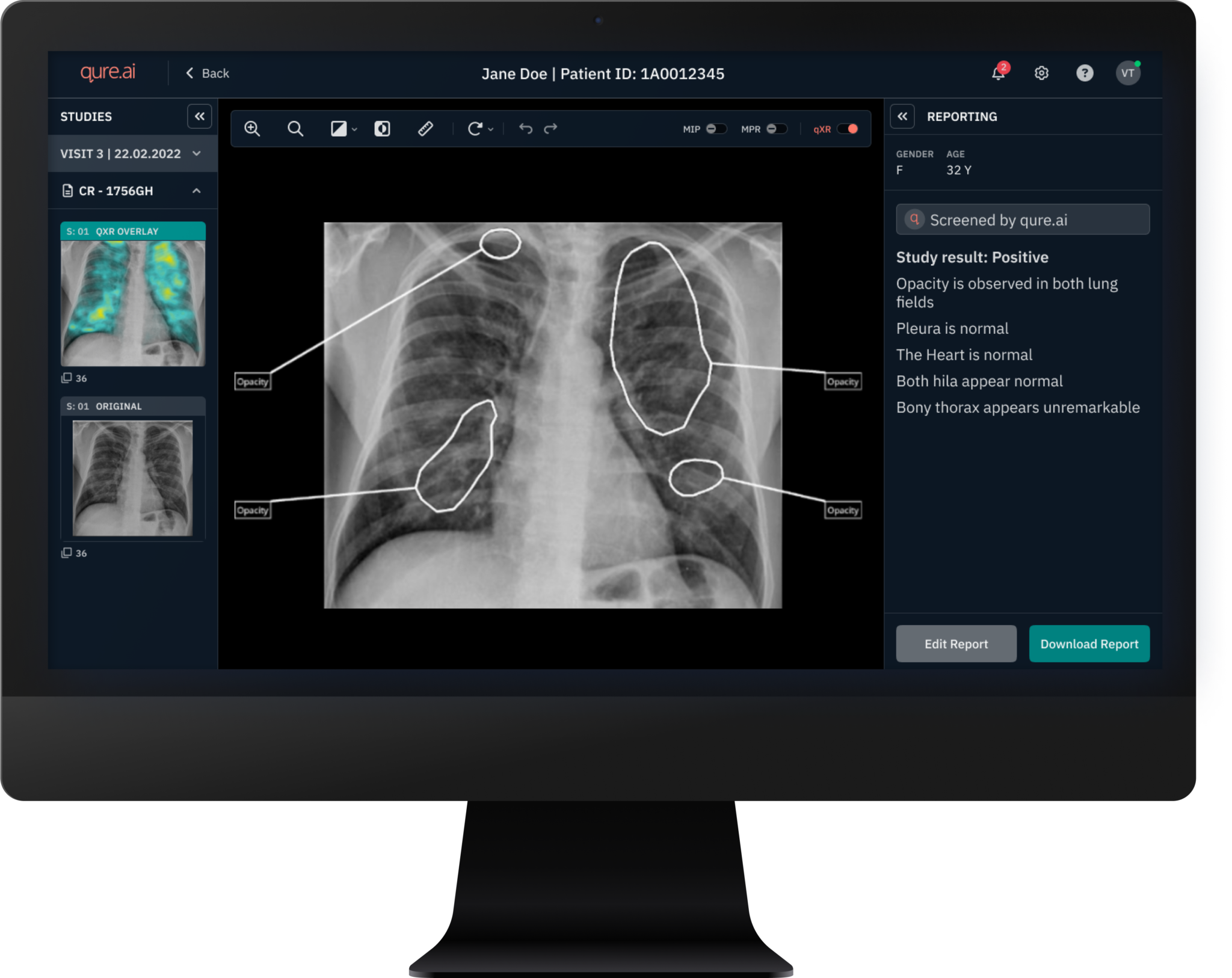 Nhsggc Trials Ai Powered X Rays In Fight Against Lung Cancer Nhsggc